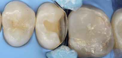 Rekonstrukcja pośrednia zęba po leczeniu kanałowym – nakład kompozytowy