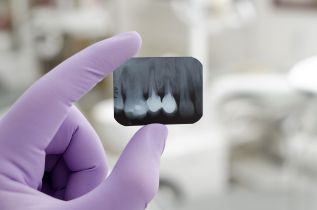 Endodoncja jest częścią stomatologii, w której leczenie bólu jest niezwykle istotne