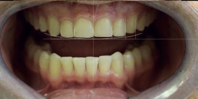 Leczenie zespołowe pacjenta z patologicznym starciem zębów