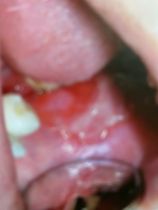 Wczesnymi objawami infekcji koronawirusem u dzieci są zmiany w jamie ustnej na błonie śluzowej