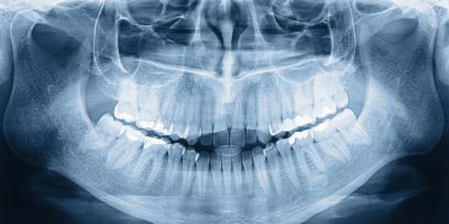 Leczenie ortodontyczne za pomocą szyn CAT, czyli clear aligner therapy