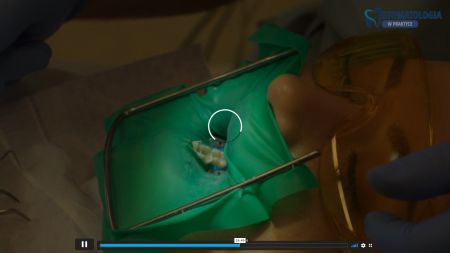 Wypełnienie protetyczne korony klinicznej zęba metodami pośrednimi i bezpośrednimi Etap I: szlifowanie zęba i pobieranie wycisku