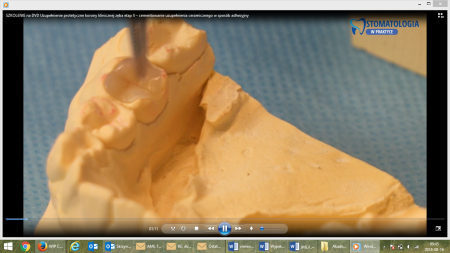 Wypełnienie protetyczne korony klinicznej zęba. Część II. Cementowanie uzupełnienia ceramicznego w sposób adhezyjny