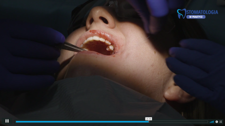 Ekstrakcja zęba ósmego zatrzymanego