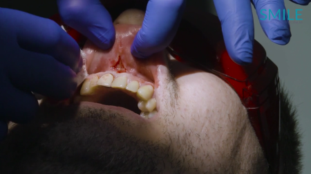 Chirurgiczne wydłużenie korony klinicznej zęba